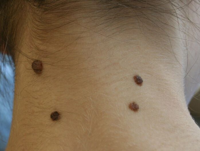 papillomas on neck)