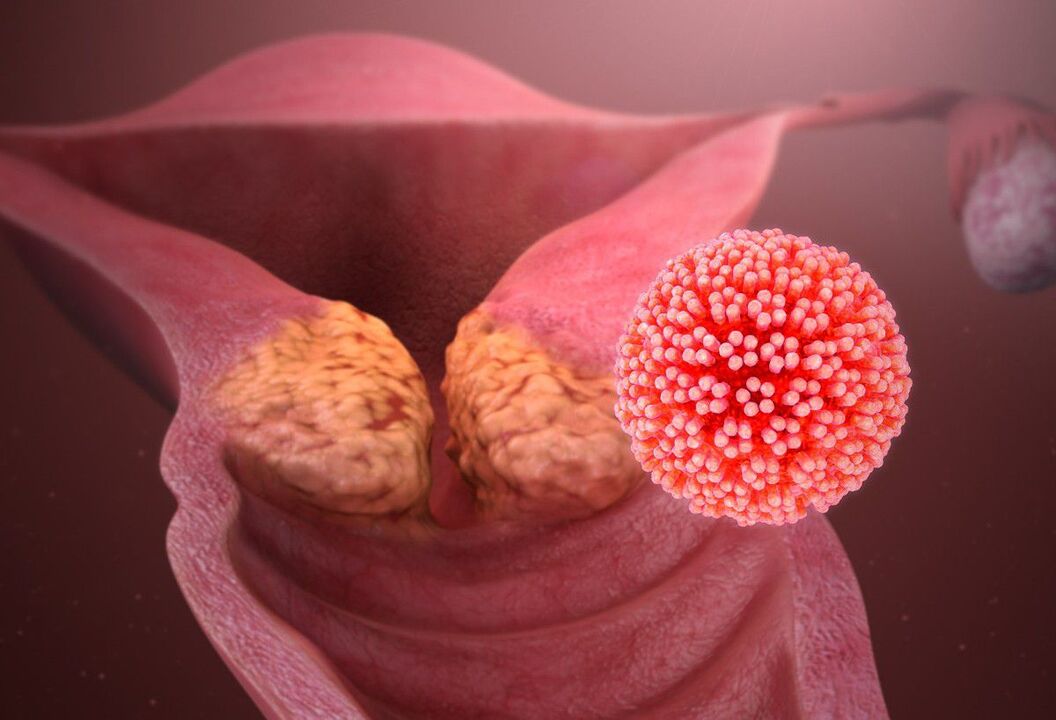 Cervical HPV lesion