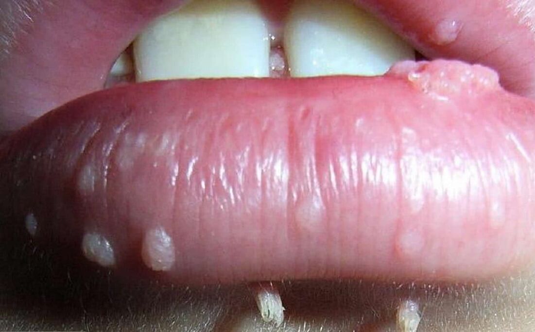 Papilloma virus al labbro. Papilloma virus labbro