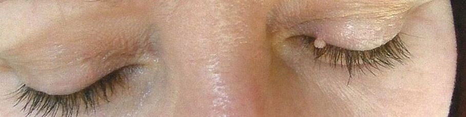 eyelid papilloma