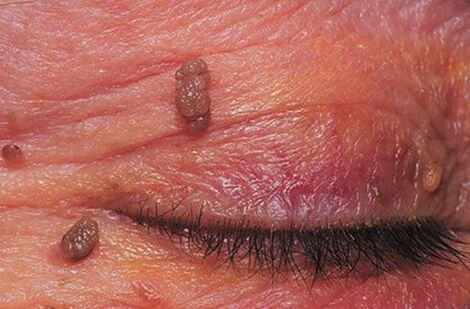 Papillomas on the skin of the eyelids that require treatment