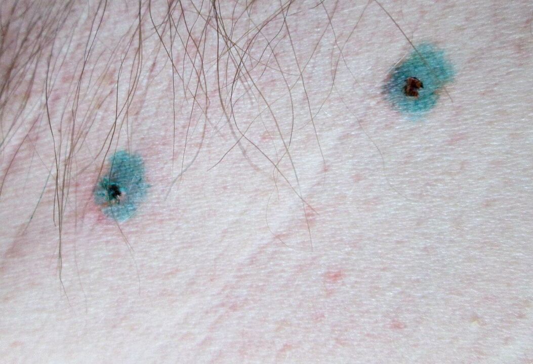 Marks on the skin after laser papilloma removal