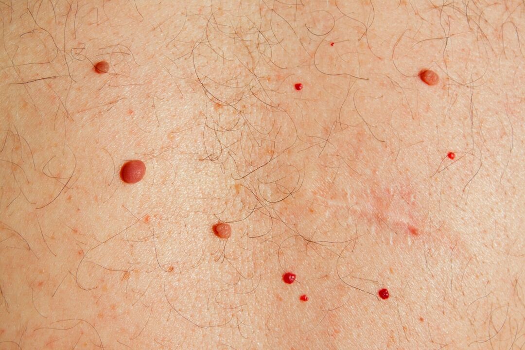 Papillomas on the body caused by HPV