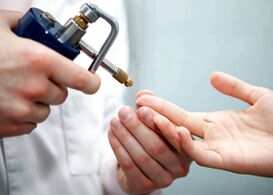 Removing a wart on your finger using liquid nitrogen