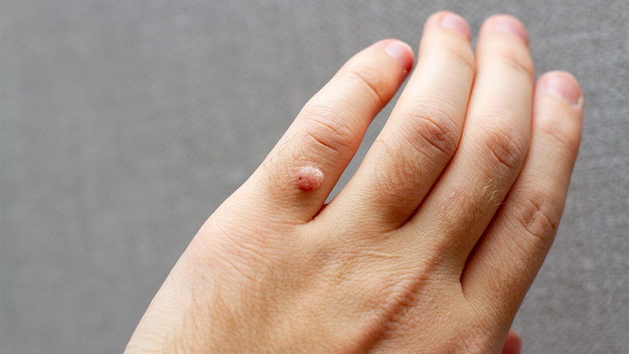types of skin warts