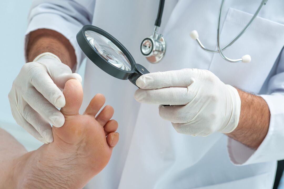 wart treatment by a doctor